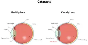 diagram of a healthy lens and a cloudy lens in an eye