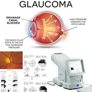 Glaucoma image showing eye anatomy, fluid blockage, and optic nerve damage, with an eye exam device