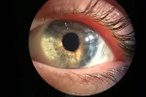 A close-up of a human eye with a bright light illuminating the iris and pupil, showing a detailed view of the eye's structure and the reflection of light on the cornea.