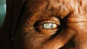 Close-up of an elderly person's eye with a cataract visible as a white spot in the pupil.