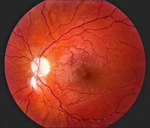 Retinal fundus image showing a healthy retina with no visible abnormalities.